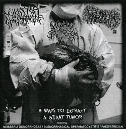 Blenorrhagical Spermatocystitis : 3 Ways To Extract A Giant Tumor